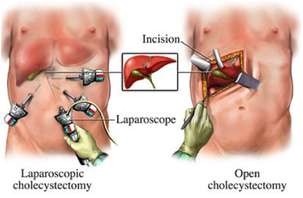 dw-laparoscopic-appendix-surgery-and-open-surgery