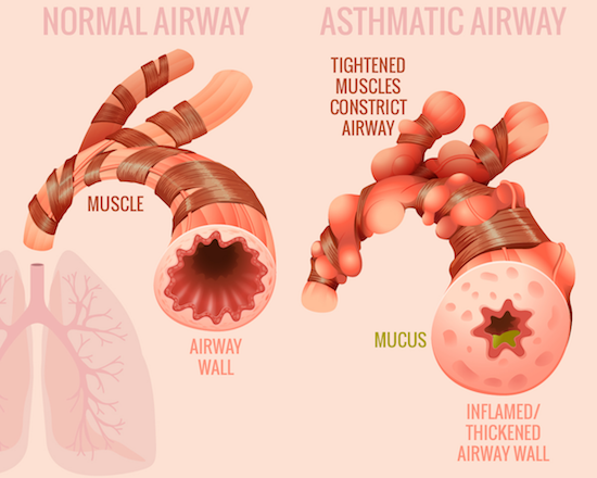 asthma